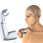 prosthesis diagram